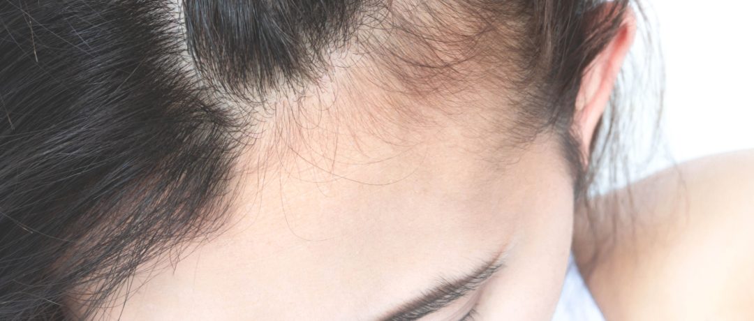 Thinning Hair & Scalp Issue Treatment London | Waterhouse Young