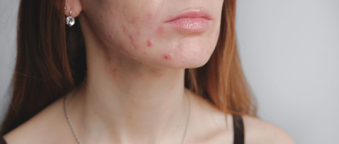 a patient having acne treatment in london at the waterhouse young clinic