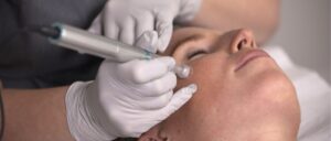 a patient having microneedling treatment in london at the waterhouse young clinic