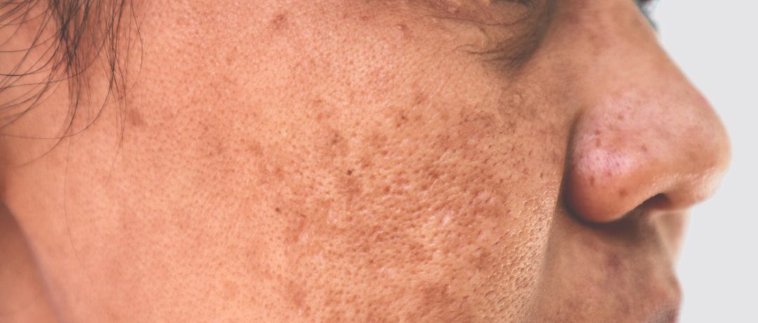 a woman suffering from sun damaged skin and pigmentation in london at the waterhouse young clinic
