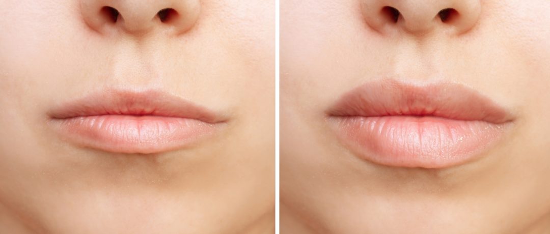 a before and after photo of a woman who had treatment for thinning lips in london at the waterhouse young clinic